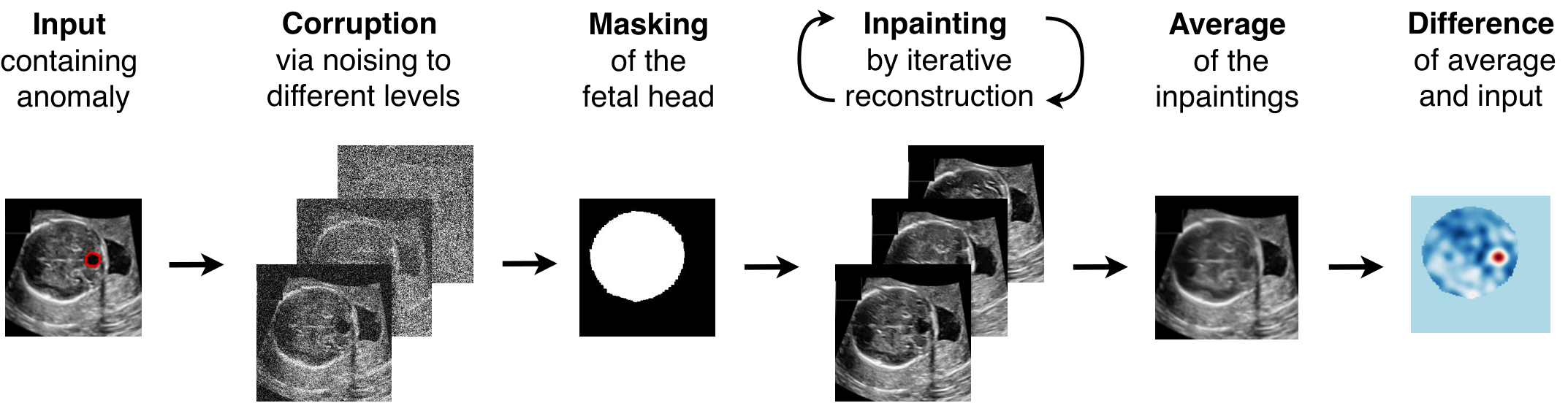 Diffusion-based fetal brain anomaly detection pipeline